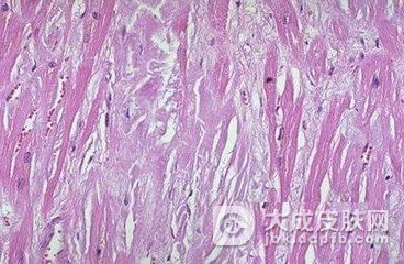 肝淀粉样变性的治疗