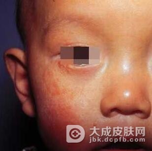 患了幼年性黄色肉芽肿怎么护理