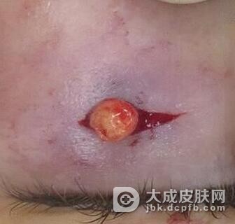 幼年性黄色肉芽肿的治疗方法有哪些
