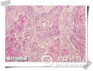 鳞状细胞癌的饮食治疗方法
