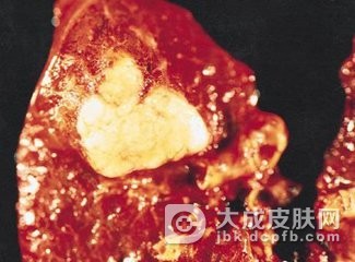 鳞状细胞癌发生及类型介绍