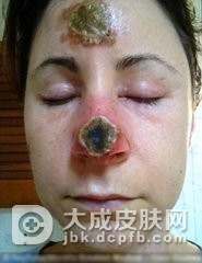 简析口腔鳞状细胞癌的病理学特点