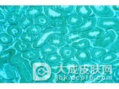 什么是高分化的鳞状细胞癌