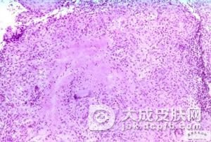 硬红斑与冷超敏反应
