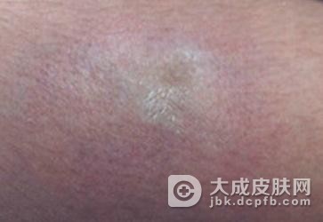 系统性硬皮病有哪些危害