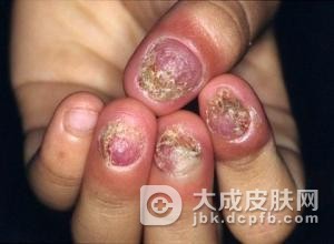 如何预防甲癣