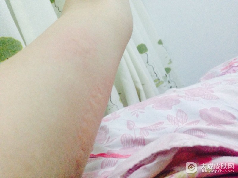 怎么预防急性荨麻疹