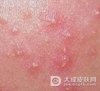 皮脂腺增生应该如何保养皮肤