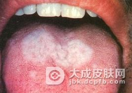 不讲究卫生引起粘膜白斑病