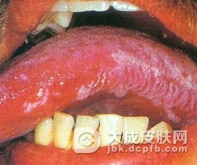 粘膜白斑病与饮食有关