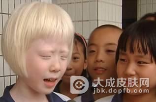 白化病的危害