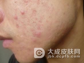 暴发性痤疮应如何鉴别诊断呢