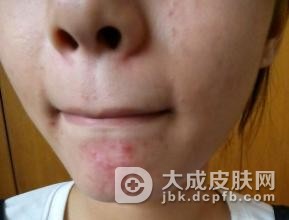 暴发性痤疮的病因及发病机制