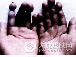 趾断症有哪些治疗措施