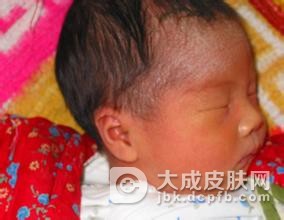 小儿脓疱疮会出现什么症状