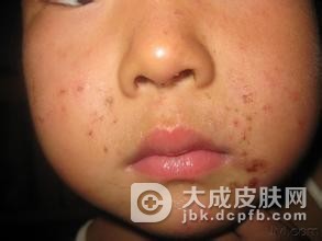 如何做好脓疱疮预防措施