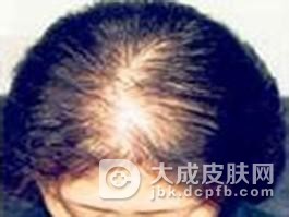 生长期脱发的保健