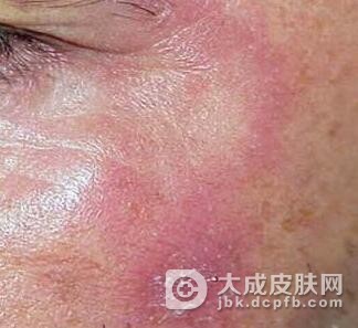 关于多形性日光疹知识