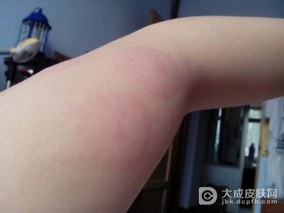 胆碱能性荨麻疹的常识