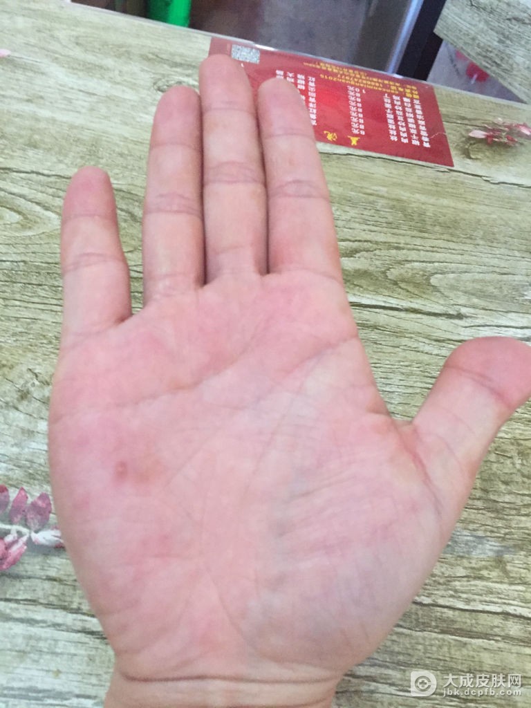 头皮湿疹治疗 