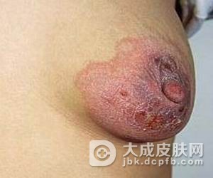 乳房湿疹有哪些症状表现