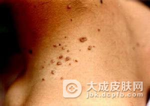 外阴软纤维瘤是怎么形成的呢