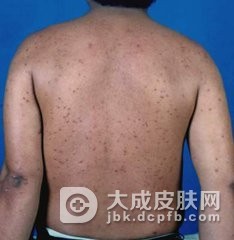 黄瘤病的患者如何的护理呢