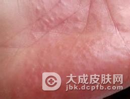 怎样判断自己是否患有汗疱疹