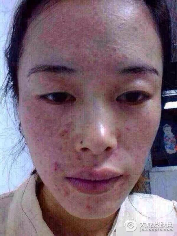 发生皮肤过敏吃什么好