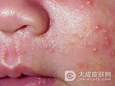 水痘的临床表现