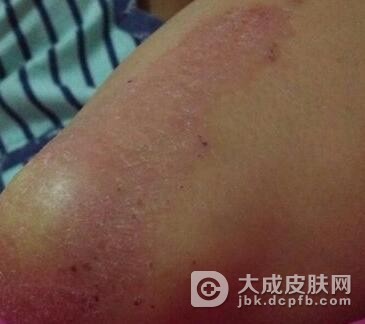 患有明癣应该怎么办
