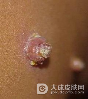 角化症对皮肤有什么伤害