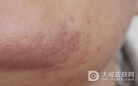 了解梅毒的传达路径避免感染