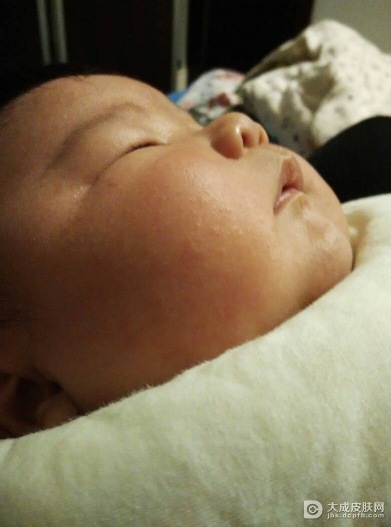 婴儿湿疹应该如何诊断？