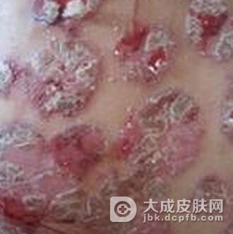 牛皮癣的发病诱因是什么