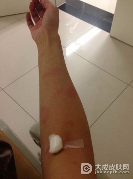 急性荨麻疹会引发发热症状