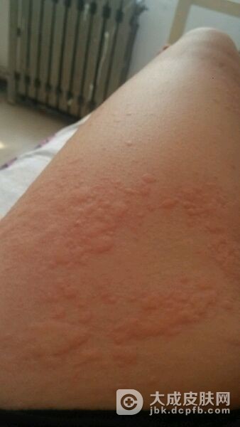 急性荨麻疹患者不能吃什么