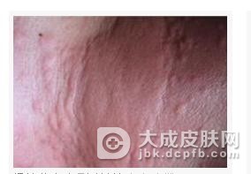 急性荨麻疹症状表现