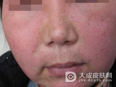 异位性皮炎应该怎么样预防