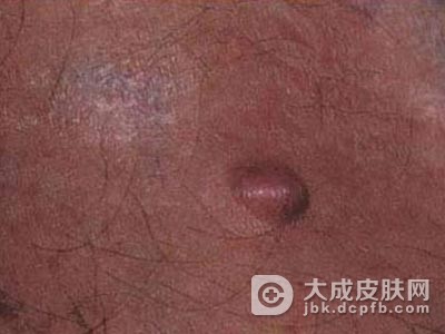肝脏脂肪瘤的中医治疗
