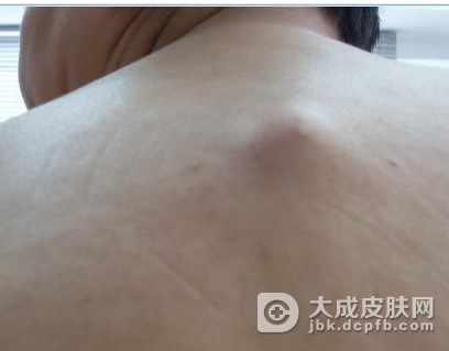 脂肪瘤的症状和检查