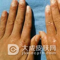 传染性湿疹样皮炎的护理