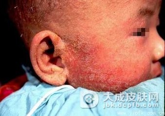 传染性湿疹样皮炎的治疗偏方