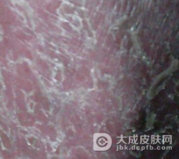 红皮型牛皮癣护理方法有哪些呢