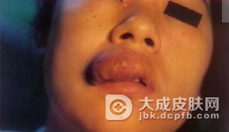 试分析小儿遗传性血管神经性水肿