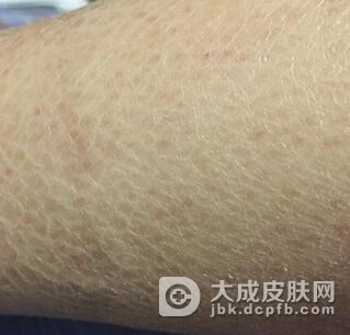 预防鱼鳞病的方法有哪些呢
