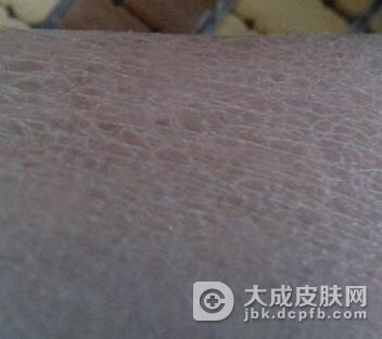 得了鱼鳞病应该特别注意什么