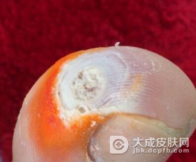 鸡眼要怎样进行护理