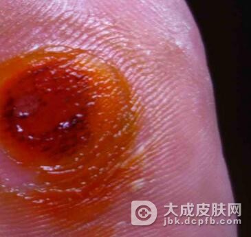 鸡眼有什么症状