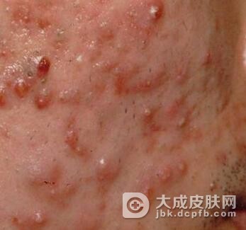 痤疮患者的饮食应该注意什么呢